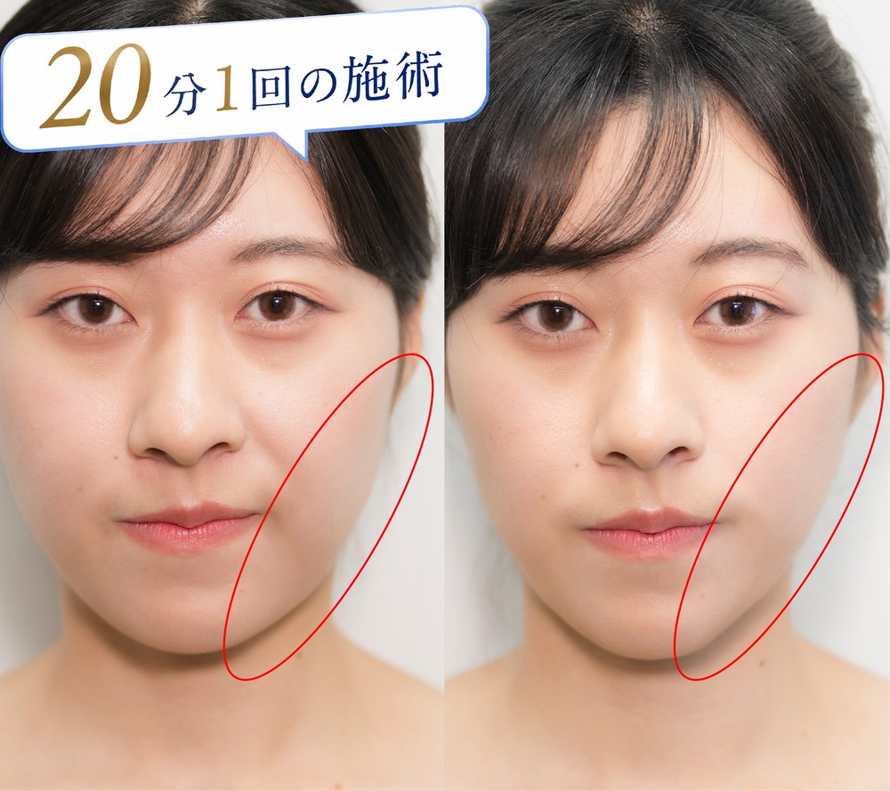 20分1回の施術 ビフォーアフター（正面）