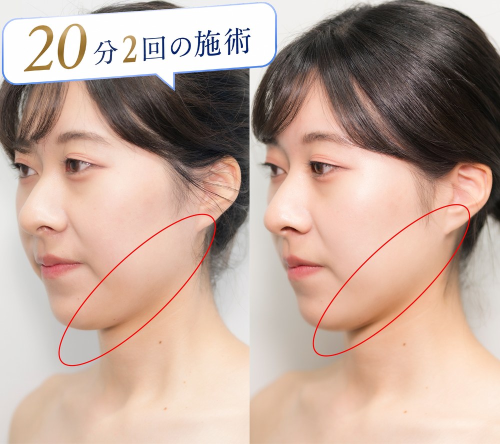 20分2回の施術 ビフォーアフター（横顔）